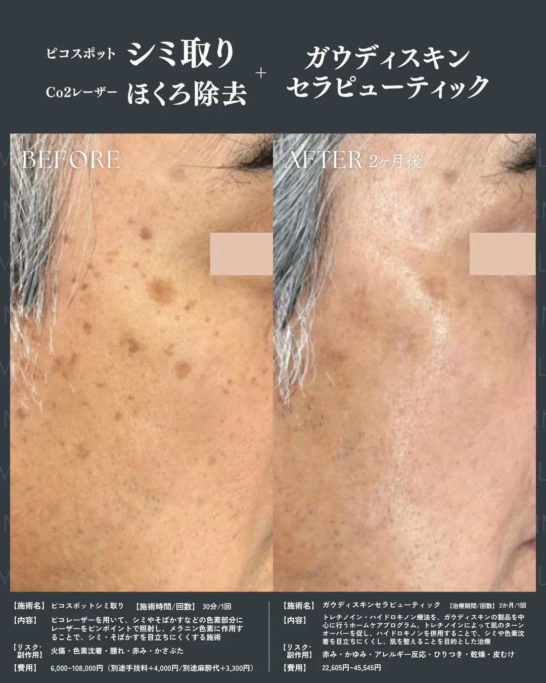 シミ取り