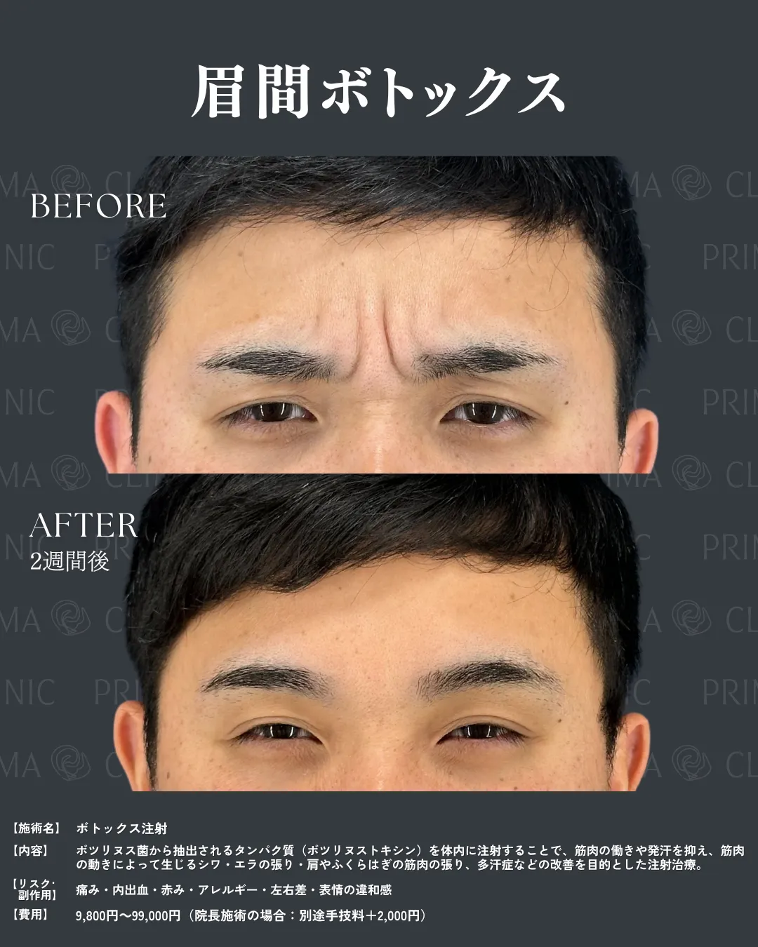 ボトックス